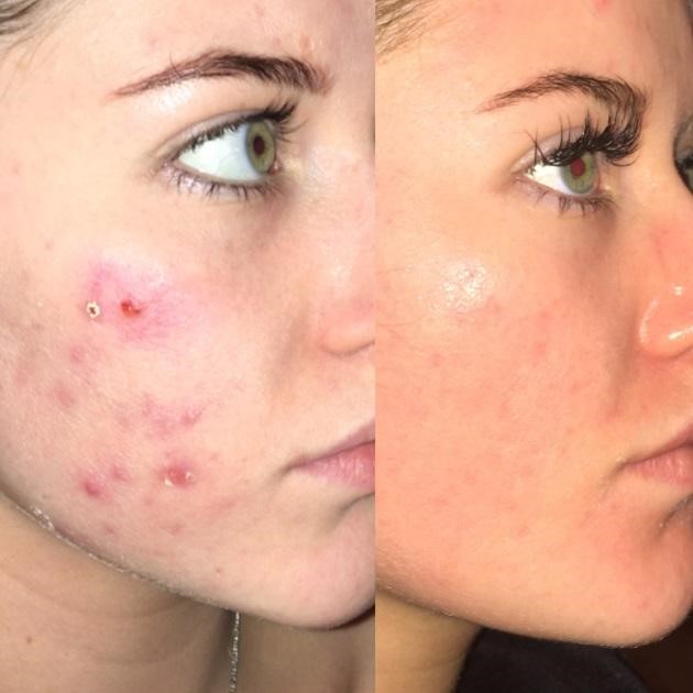 Acne Treatments Chester