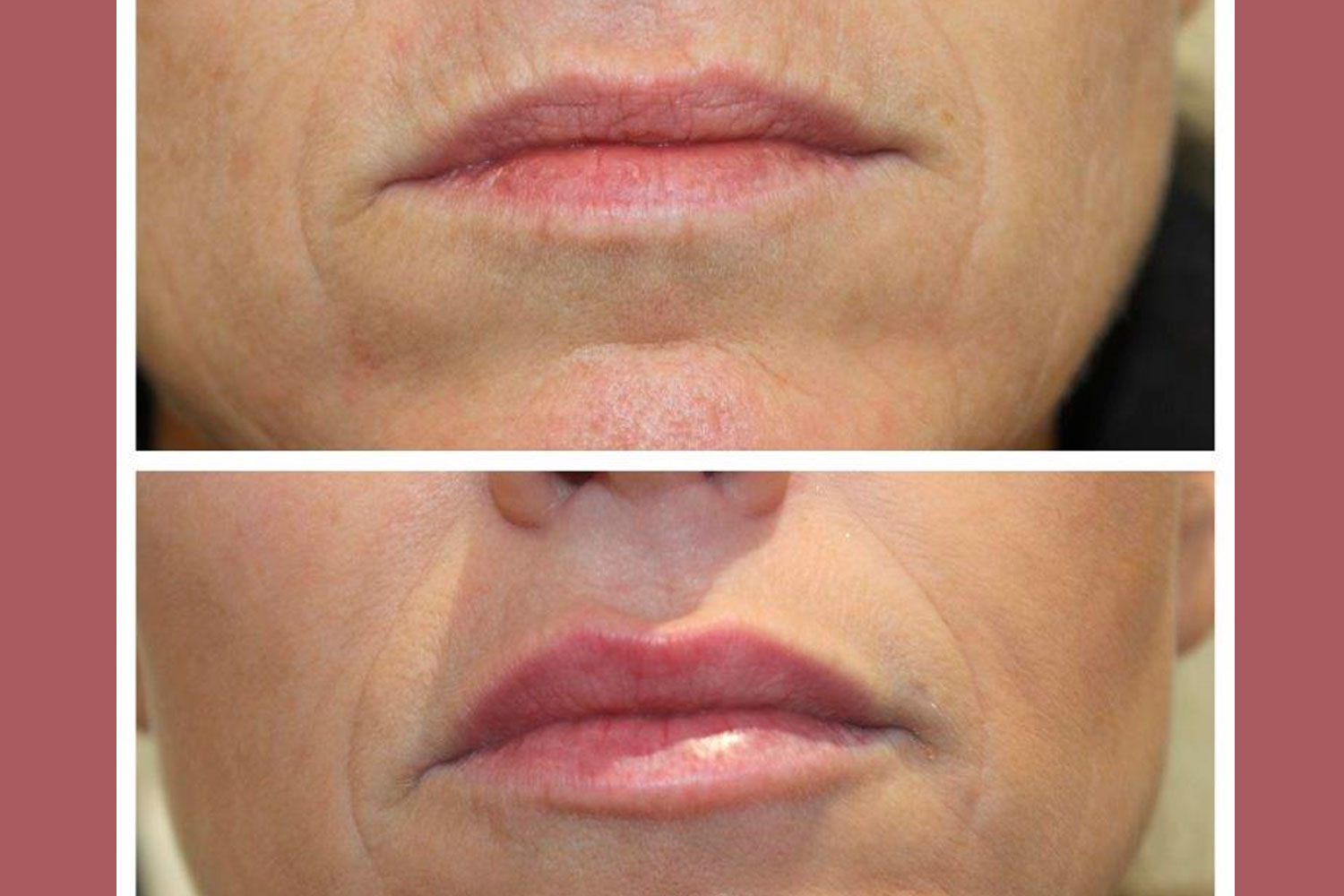 Lip Fillers Chester